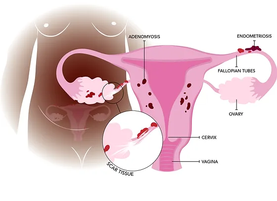 Endometriosis: Understanding Symptoms, Causes, and Management