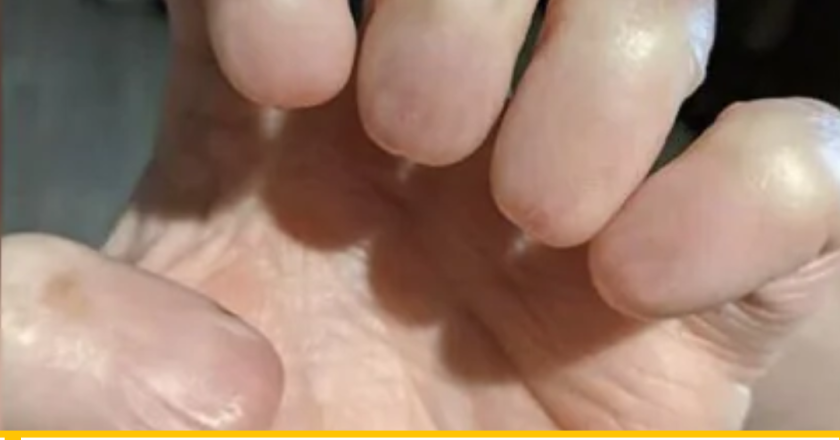 Anonychia: The Rare Nail Disorder