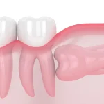 Humans Are Still Evolving: The Mystery of Shrinking Jaws and Disappearing Teeth